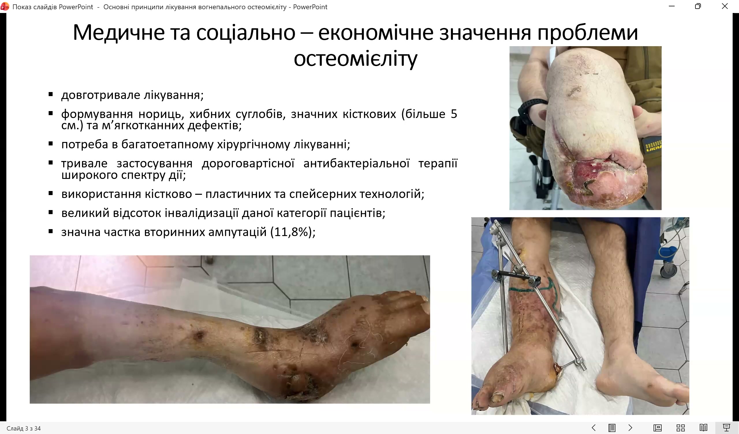 Вогнепальний остеомієліт довгих кісток: діагностика та етапна реконструкція